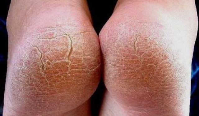 Çatlayan Topuklara Ne İyi Gelir? Evde Bakımda Doğru Adımlar