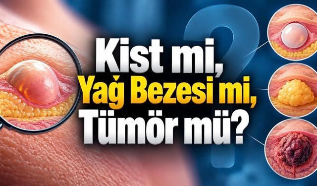 Çoğu Kist Zararsız Ama Her Şişlik Kist Değil: Ne Zaman Kontrol Gerekir?