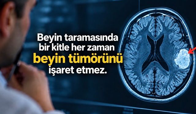 Beyin MR’ında beyaz lekeler ne anlama gelir? Nedenleri ve önemli işaretler
