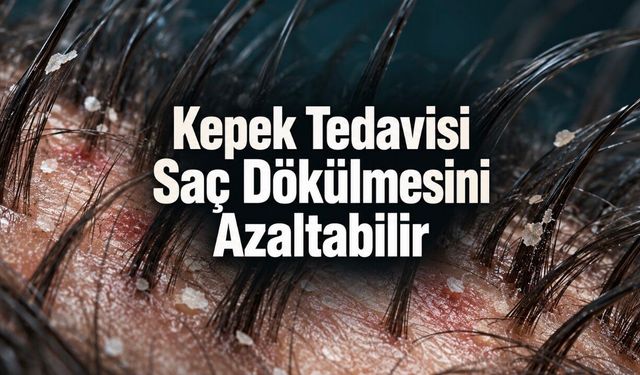 Kepek Tedavisi Saç Dökülmesini Azaltabilir: Ancak Her Dökülme Kepekten Değil