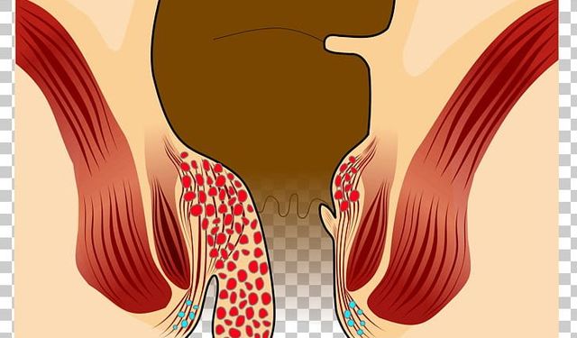 Hemoroid: Sessiz Bir Rahatsızlık, Doğru Yaklaşımla Kontrol Altında