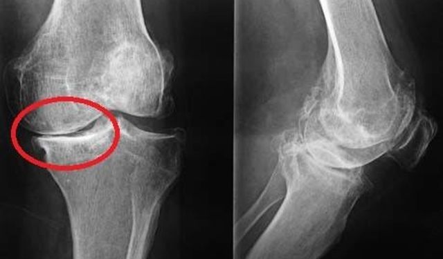 Diz kireçlenmesine karşı en etkili tedavi: Bilimsel egzersizler, enjeksiyonlar ve doğal destekler haberimizde