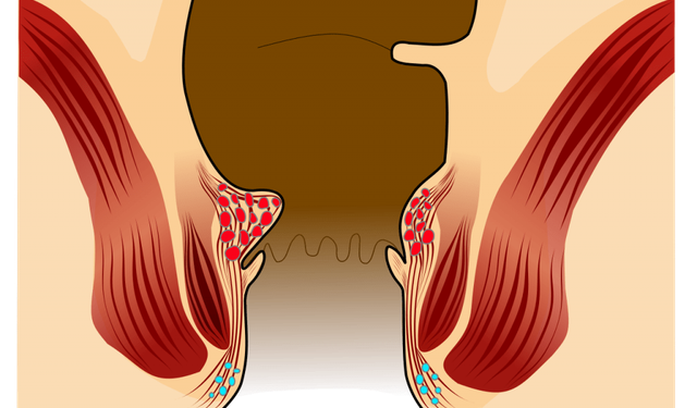 Hemoroid Krizi Sırasında Bunları Yapmayın!