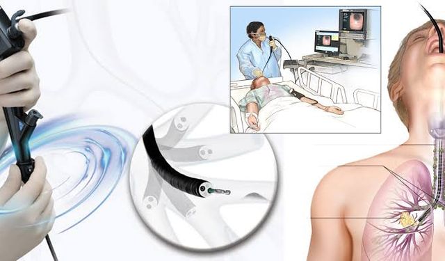 Girişimsel Pulmonoloji Nedir? Akciğer Hastalıklarında Ameliyatsız Yeni Dönem