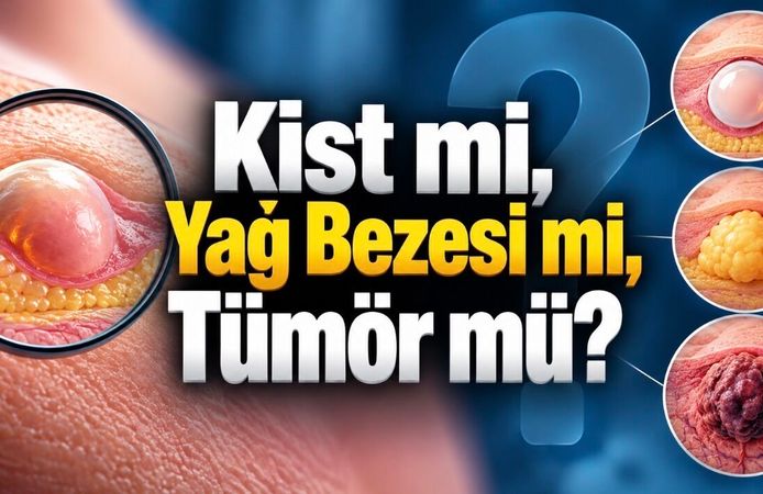 Çoğu Kist Zararsız Ama Her Şişlik Kist Değil: Ne Zaman Kontrol Gerekir?