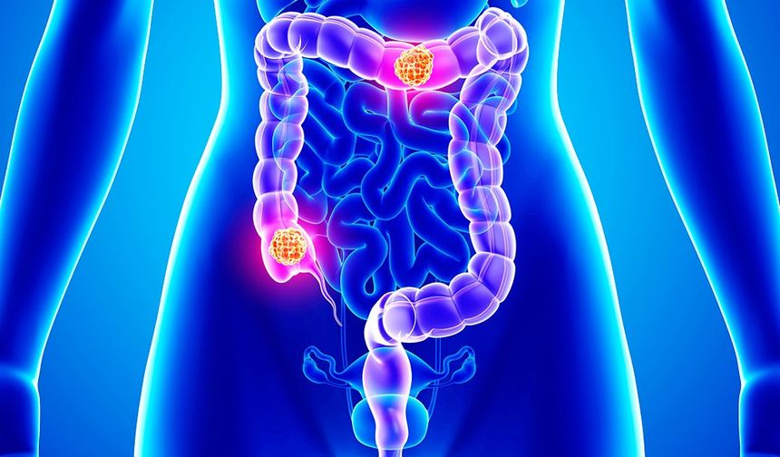 Mide kanseri: Riskler, tanı ve tedavisi