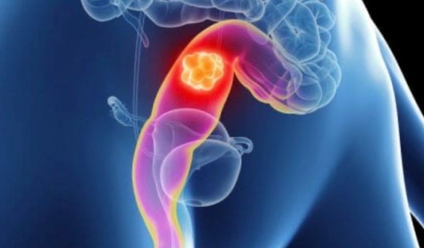 Rektum kanserinde ameliyat devri bitiyor mu? Yeni çalışma ne vadediyor?