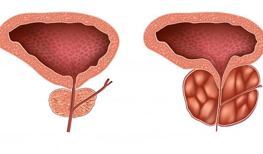 Prostatit Nedir? Belirtiler ve Tedavi Yaklaşımları