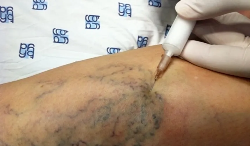 Köpükle Varis Tedavisi Nedir? Kimlere Uygun, Nasıl Etki Ediyor?