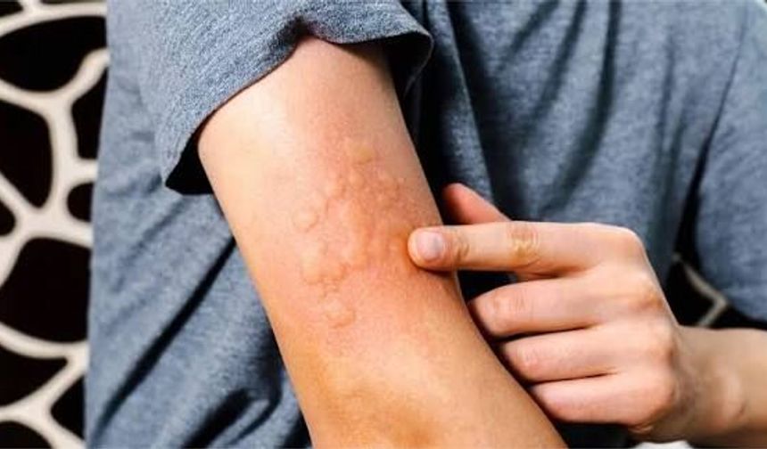 Ürtiker Nedir? Belirtileri, Türleri ve Güncel Tedavi Yaklaşımları