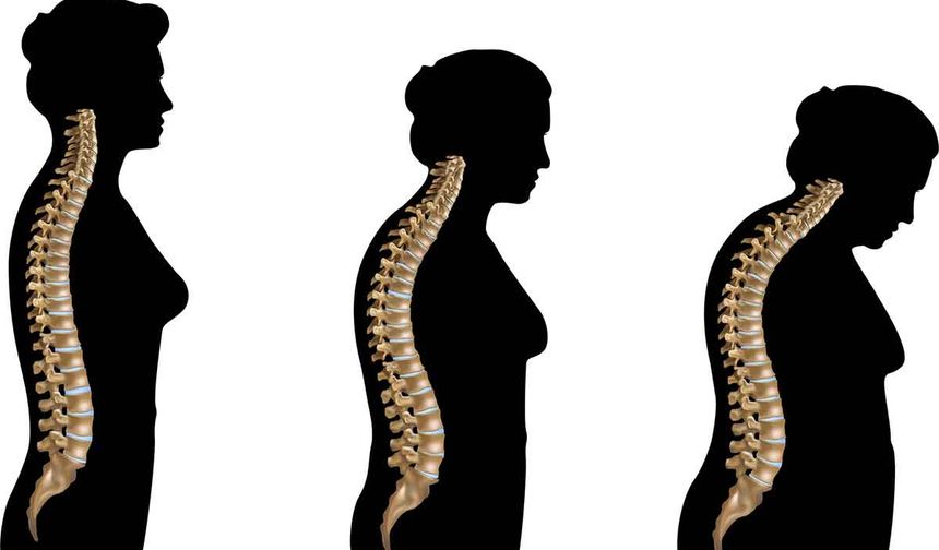 Kırık Olana Kadar Fark Edilmiyor: Osteoporoz Sessizce Nasıl İlerliyor?