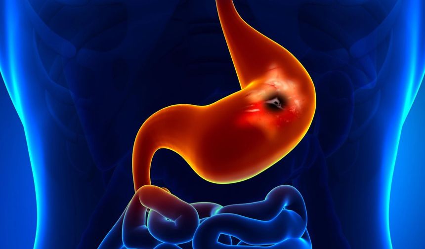 Peptik ülser nedir? En yeni teşhis ve tedavi yöntemleri