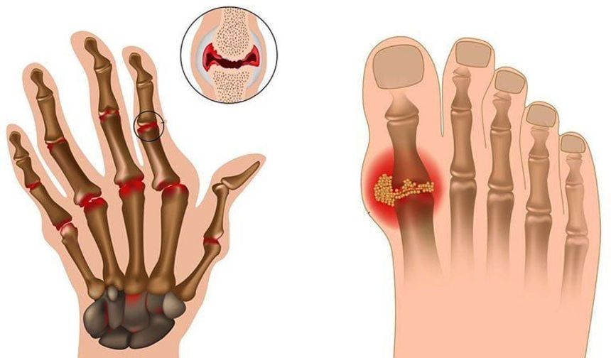 Eklem Ağrısının Nedeni Hep Aynı Değil: Artritin 6 Farklı Yüzü