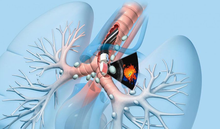 Bronkoskopi Nedir? Akciğerlerin İçine Açılan Tanı ve Tedavi Penceresi