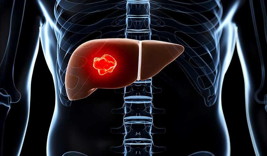 Karaciğer Kanseri Belirti Vermeden İlerliyor: Uzmanlardan Erken Tanı Uyarısı