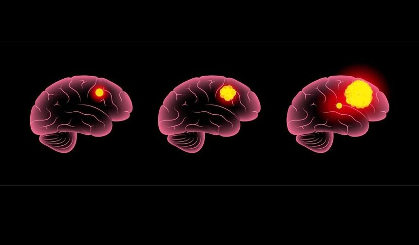 Glioblastoma nedir? Belirtileri ve en güncel tedavi yöntemleri