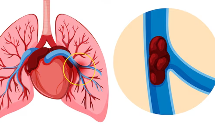 Pulmoner Emboli Nedir, Nasıl Anlaşılır? Belirti, Tanı ve Tedavide Yeni Dönem