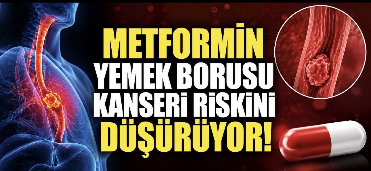 Metformin Kullananlarda Yemek Borusu Kanseri Riski Daha Düşük Bulundu